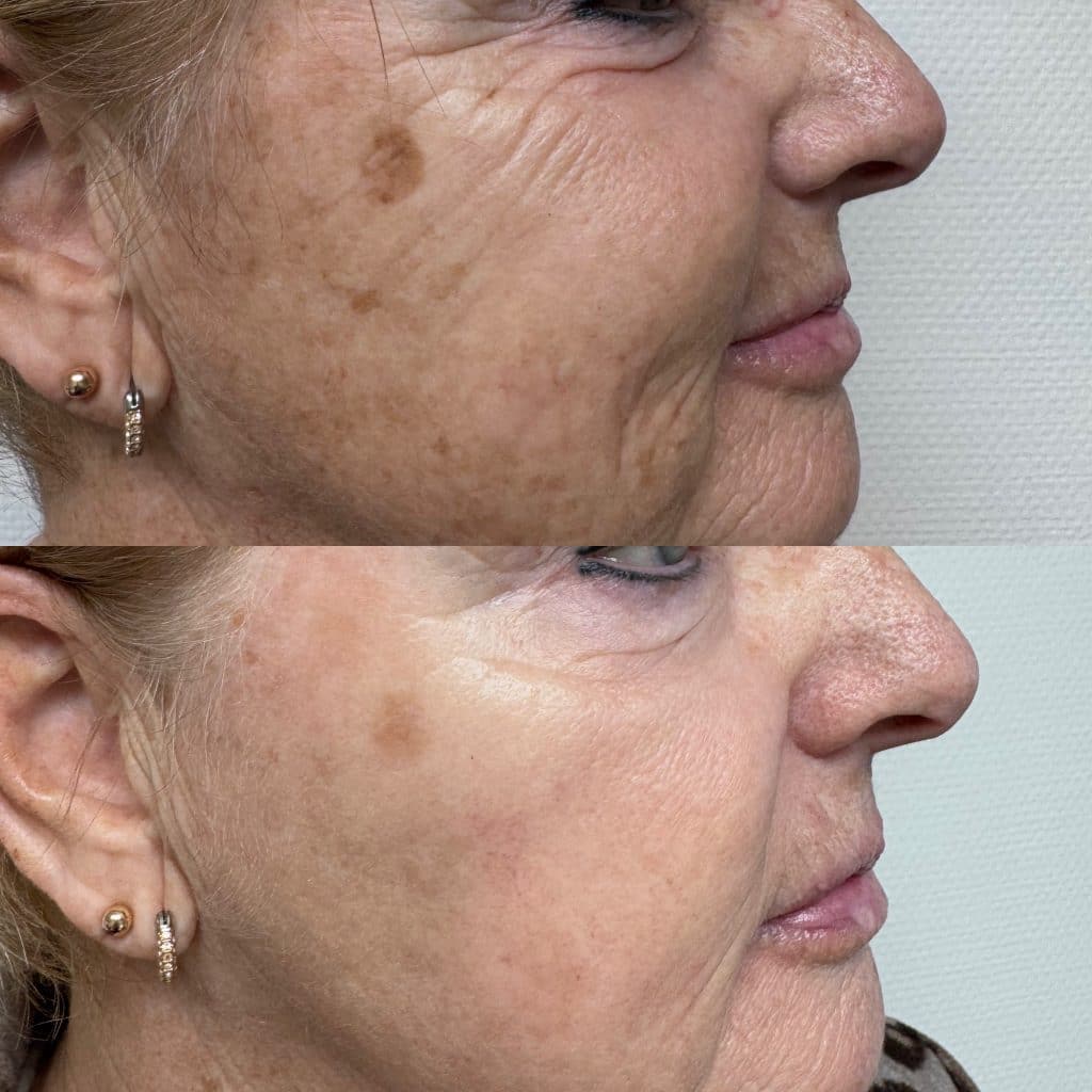 IPL pigment