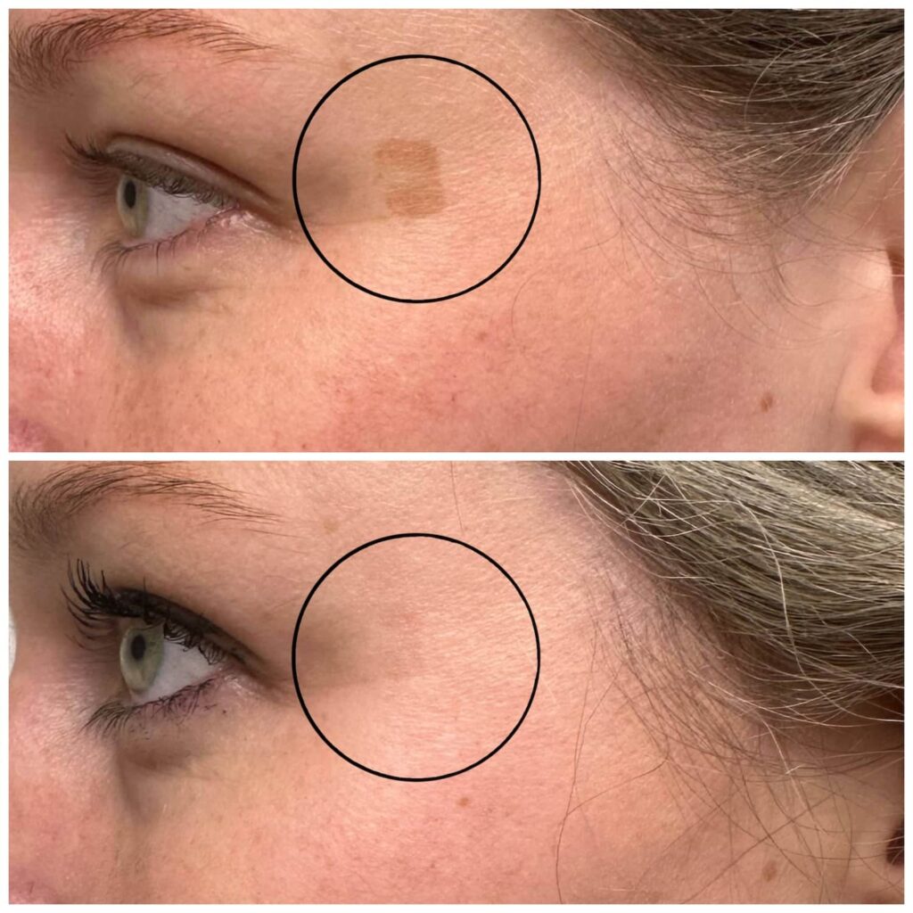 Laserspecialist_santpoort_IPL_Voorbeeld2