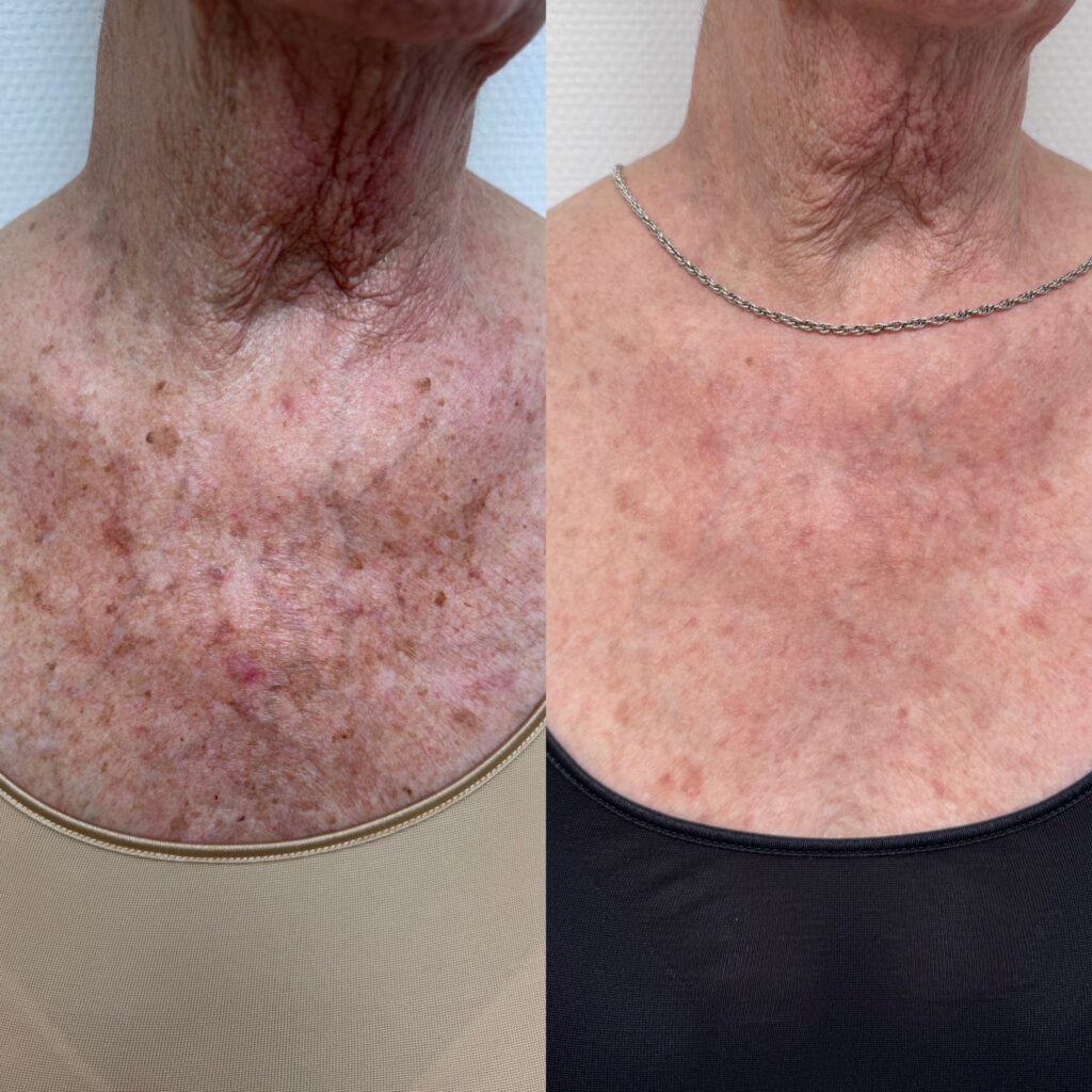 Laserspecialist_santpoort_IPL_Voorbeeld3