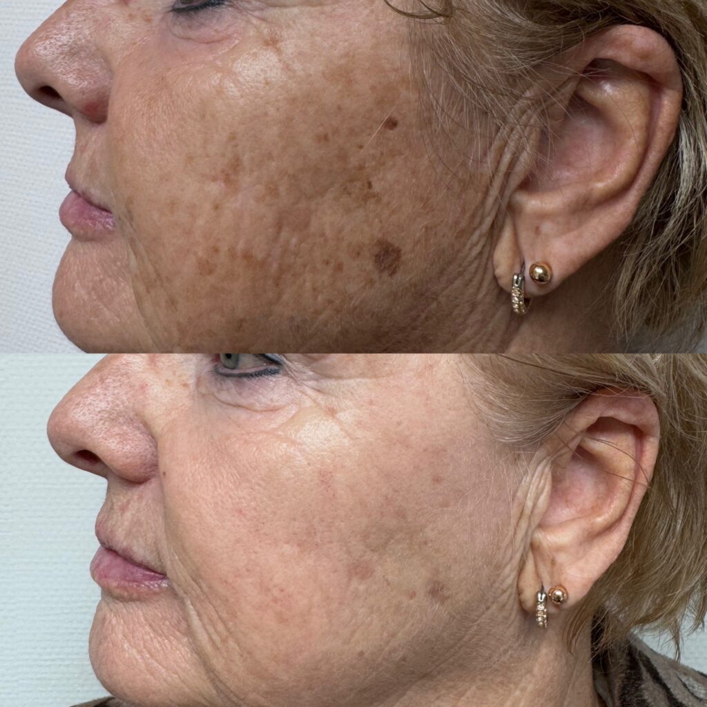 Laserspecialist_santpoort_IPL_Voorbeeld6