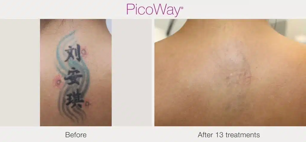 PicoWay-after-13-treatments.jpeg