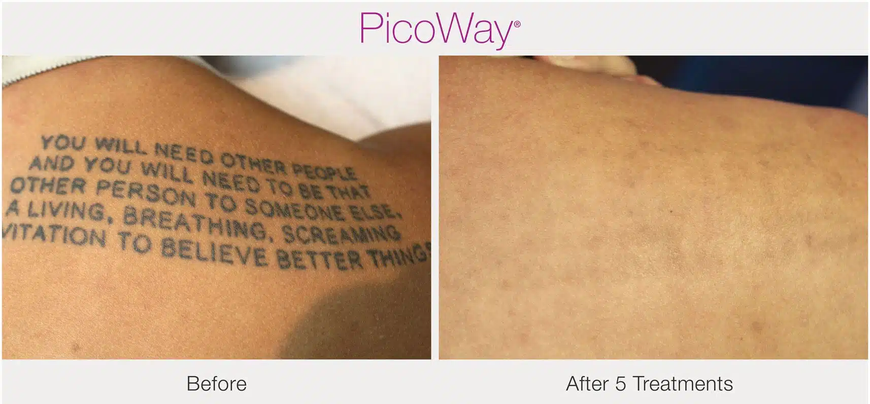 PicoWay-after-5-treatments.jpeg