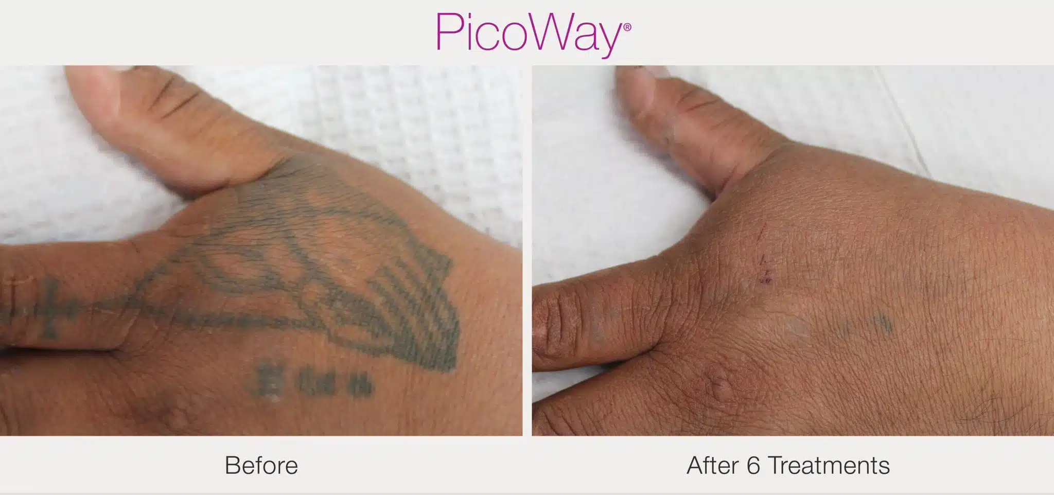 PicoWay-after-6-treatments.jpeg