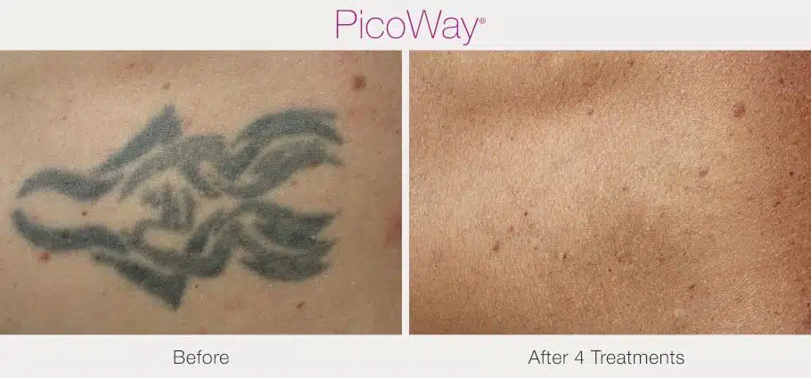 PicoWay-after-7-treatments.jpeg