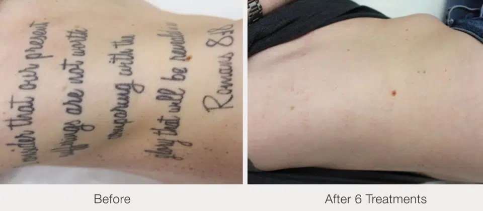 before-after-6-treatments.jpg.png